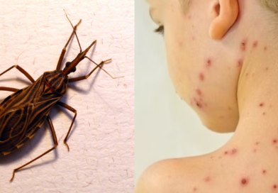 Ananindeua, no Pará, tem surto de casos da doença de Chagas